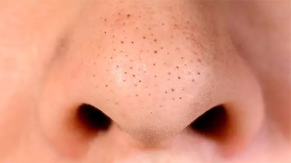 nose strips for blackheads